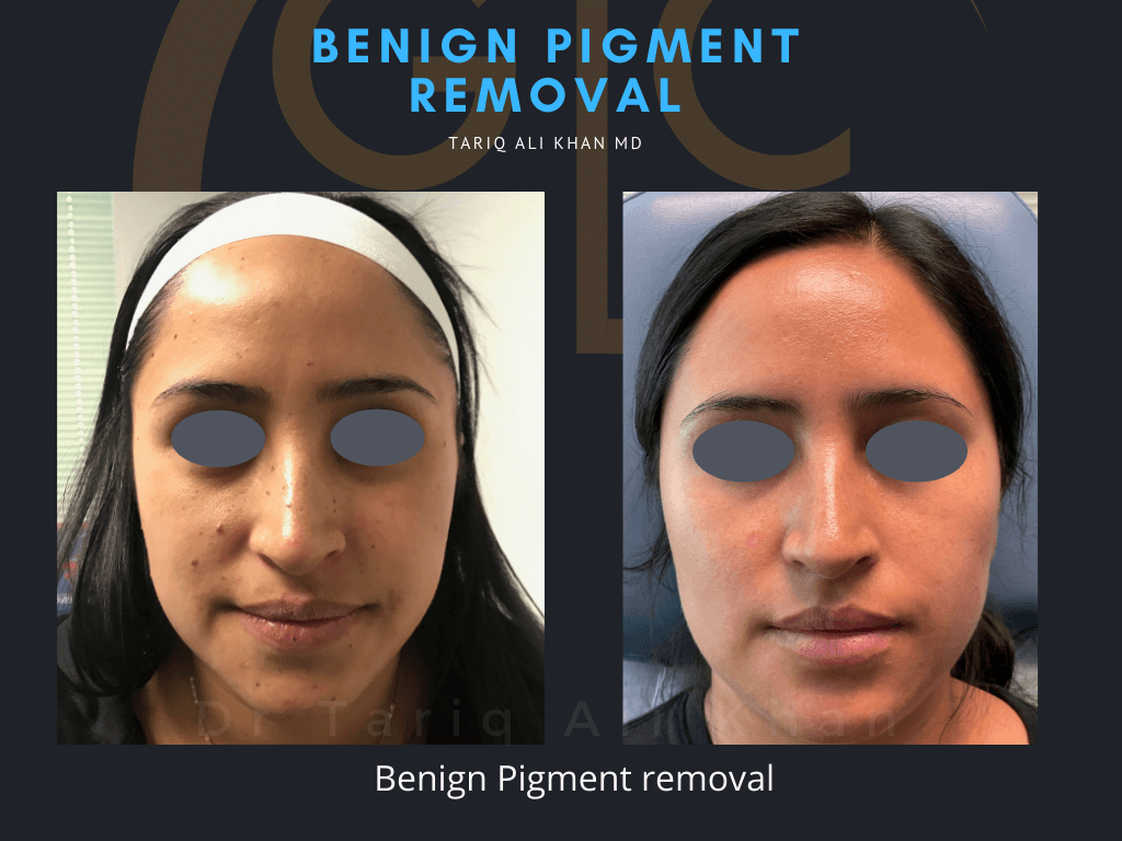 Gentle Care Laser Tustin Before and After picture - Mole Removal